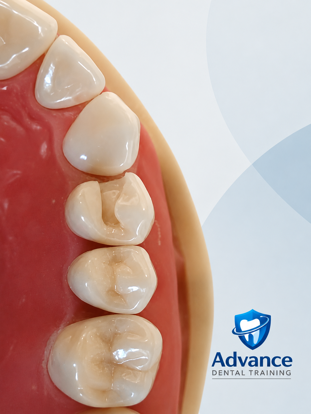 Dental model preparation example